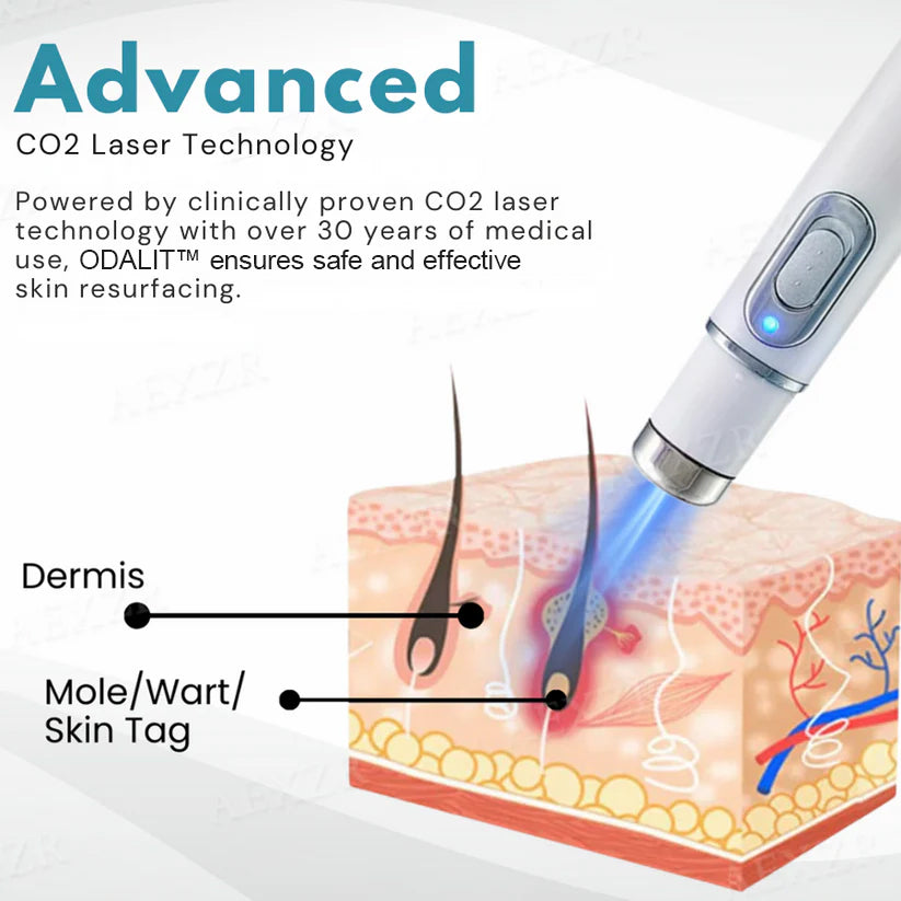 š„ODALIT⢠Non-Invasive Mole and Wart Removal Laser Penš„