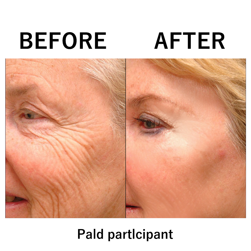 šODALITā¢Natural wrinkle removal
