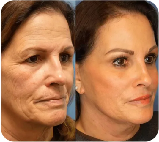 šODALITā¢Natural wrinkle removal
