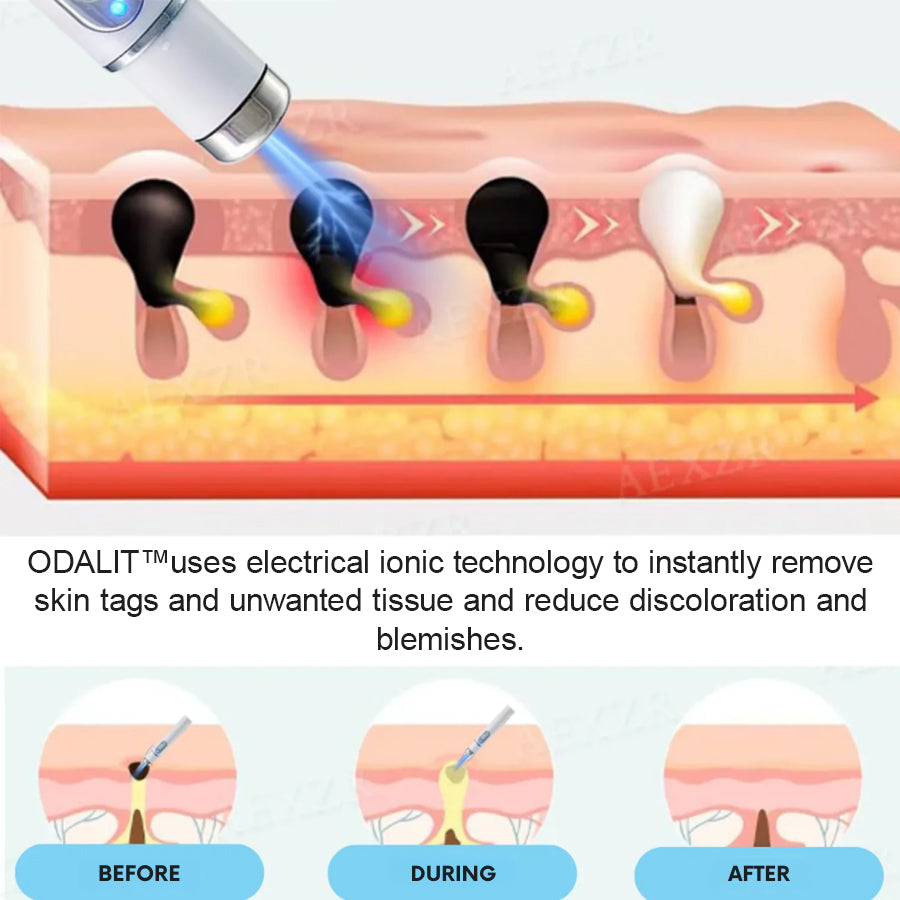 š„ODALIT⢠Non-Invasive Mole and Wart Removal Laser Penš„