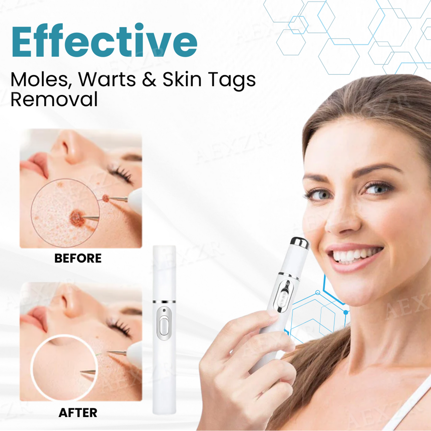 š„ODALIT⢠Non-Invasive Mole and Wart Removal Laser Penš„