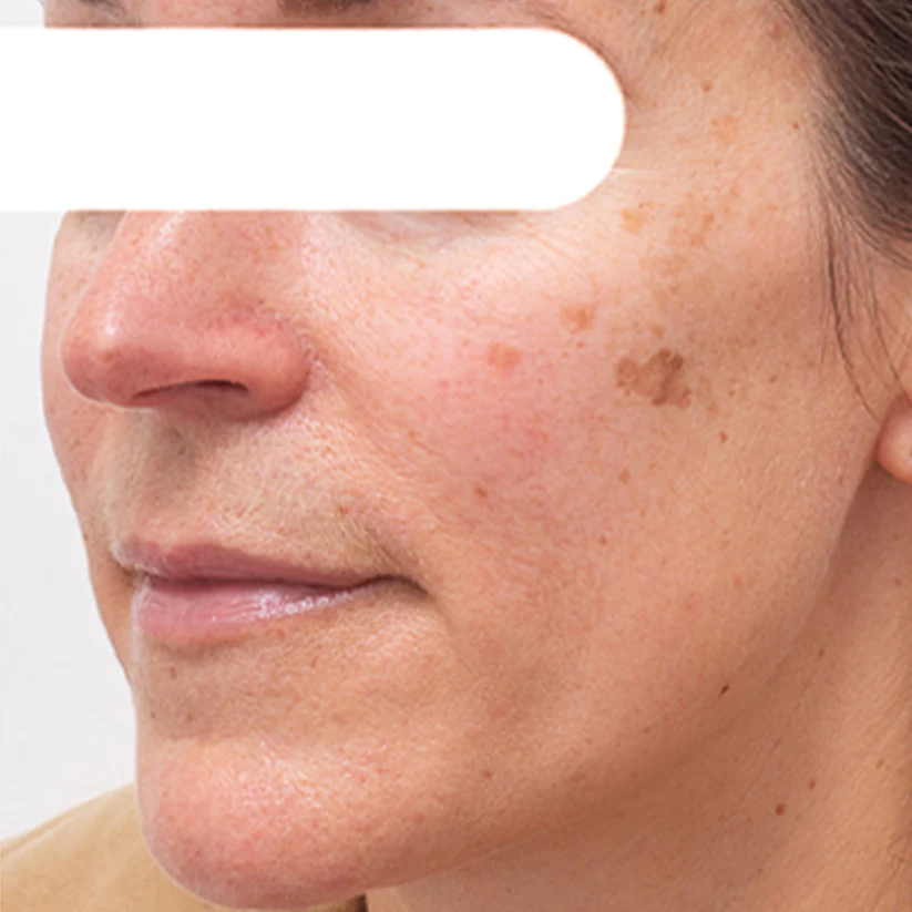 ODALITβ’ Herbal Spots β
π€ππ§π π¦π‘ π₯π ππ% Peel-Off Facial Mask