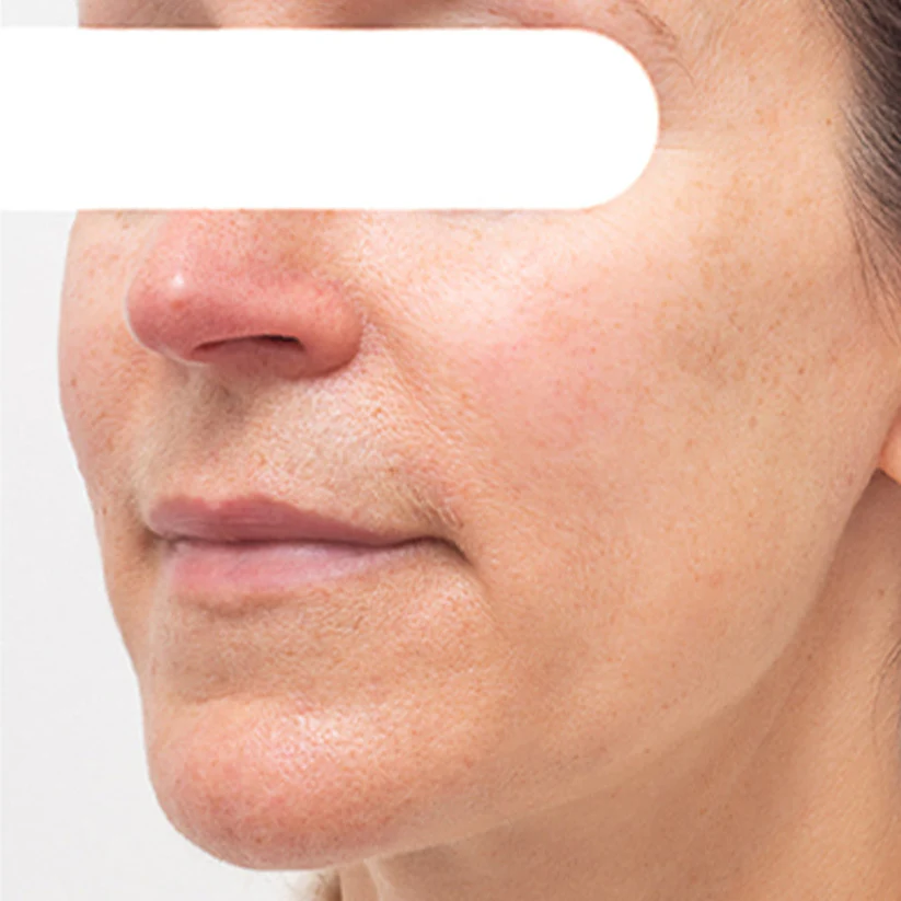 ODALITβ’ Herbal Spots β
π€ππ§π π¦π‘ π₯π ππ% Peel-Off Facial Mask