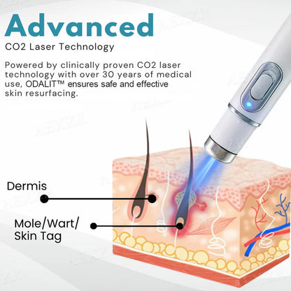 💥ODALIT™ Non-Invasive Mole and Wart Removal Laser Pen🔥
