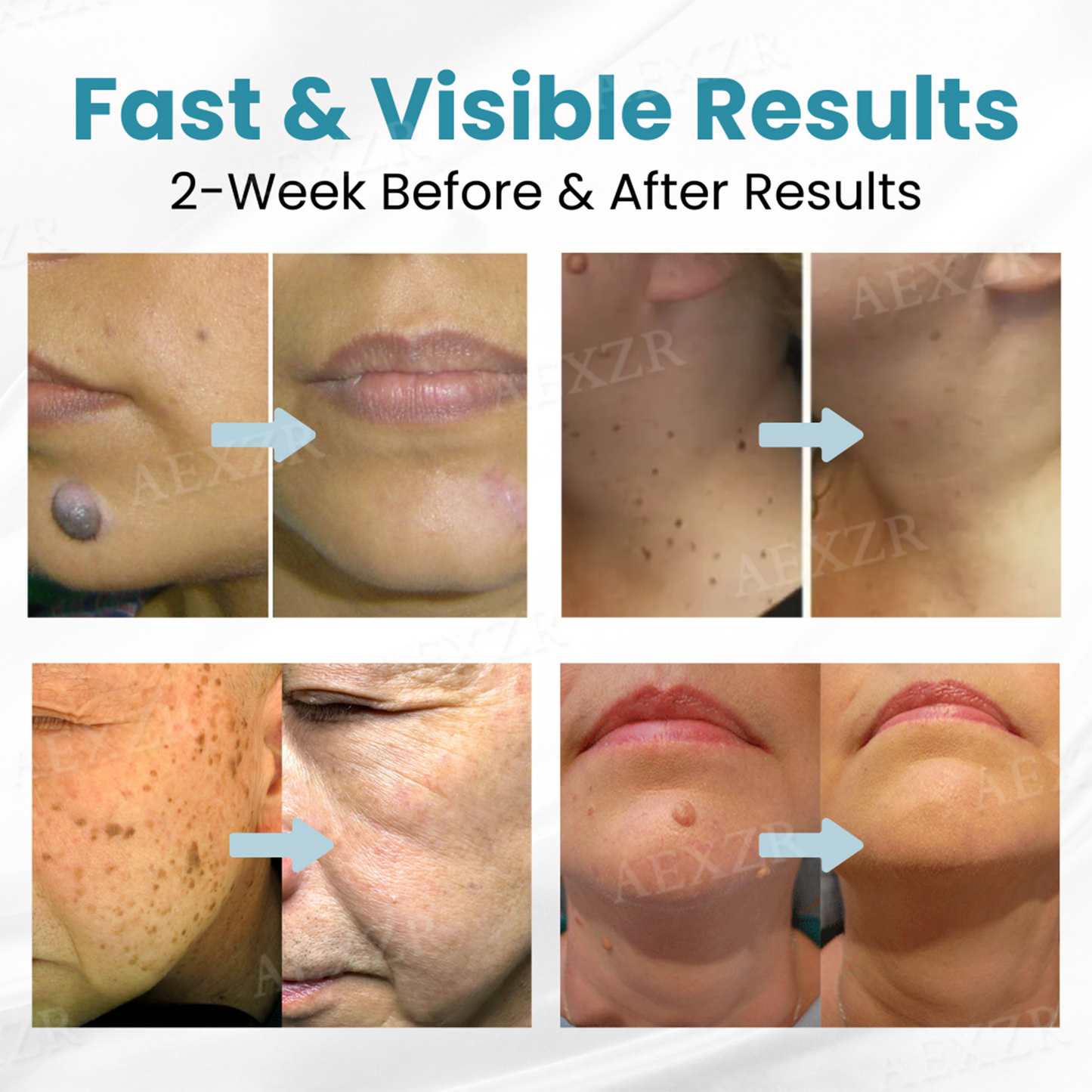 💥ODALIT™ Non-Invasive Mole and Wart Removal Laser Pen🔥