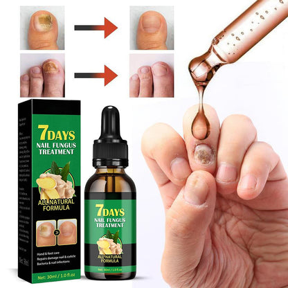 💅Refuse nail rot, ginger nail treatment👣