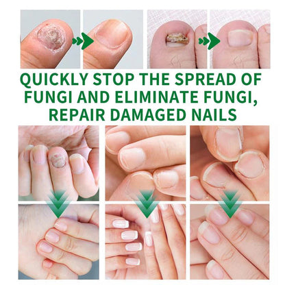 💅Refuse nail rot, ginger nail treatment👣
